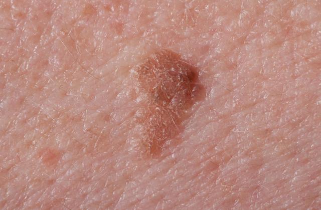 一般都是发生在外生殖器或是肛周等位置,颜色多为粉红色的菜花状,很