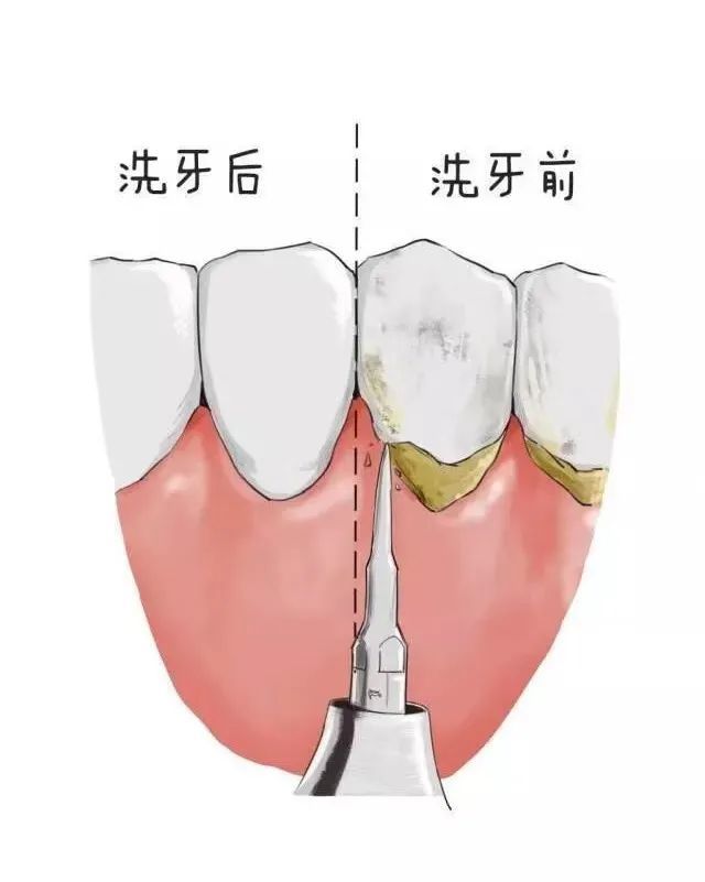 洗牙到底洗掉了什么