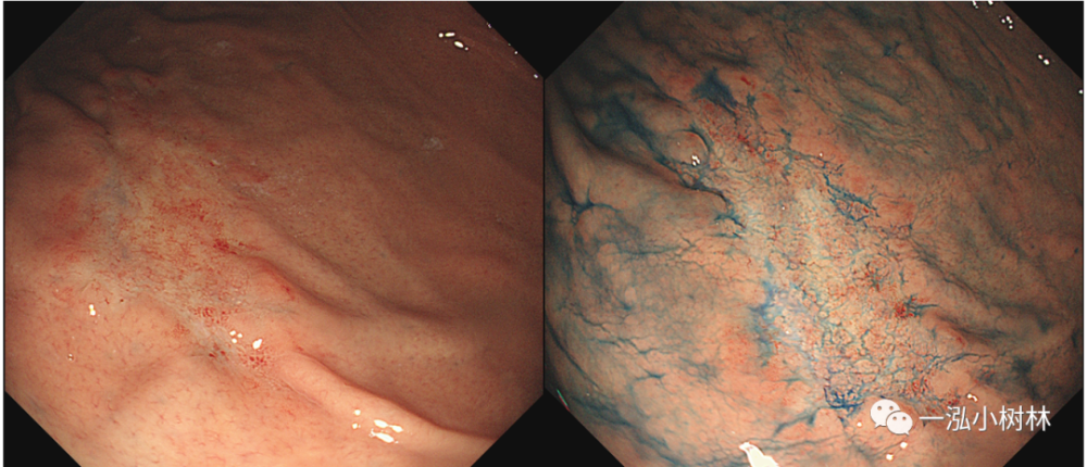 胃malt淋巴瘤内镜下特征:胃体褪色病变
