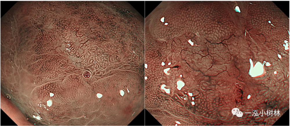 胃malt淋巴瘤内镜下特征胃体褪色病变