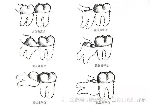 看圖吧,這些阻生情況各異的智齒如果一次性全部拔除掉,勢必會因為患者