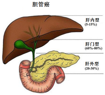 得了胆管癌该怎么办 腾讯新闻