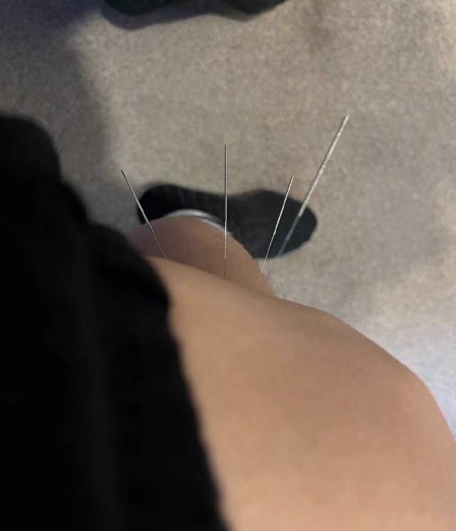 邓超为等等小花做榜样,身体没病却被针灸14针,自侃是"针模"