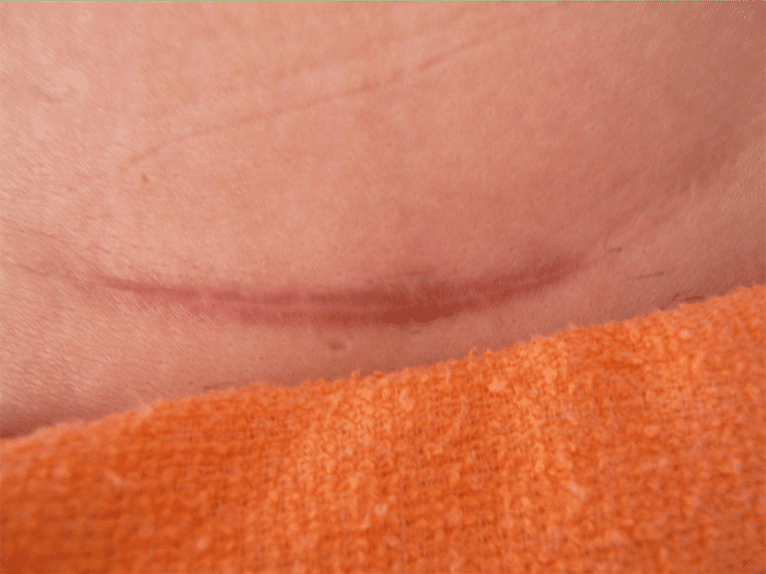 女朋友肚子有道十公分左右的疤,她说小的时候爬树划的,是真的吗?