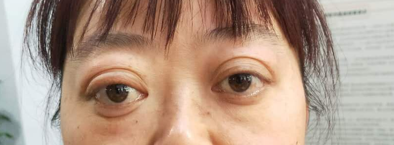 母亲和男朋友同时:患甲亢,但症状却完全不同