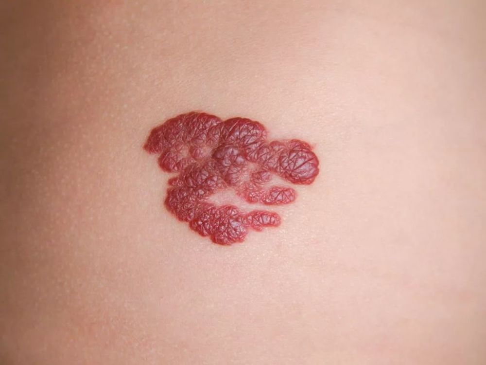 这种痣要留意,5种情况当心皮肤癌!