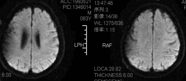 这例dwi 高信号,不要误诊为脑梗死!