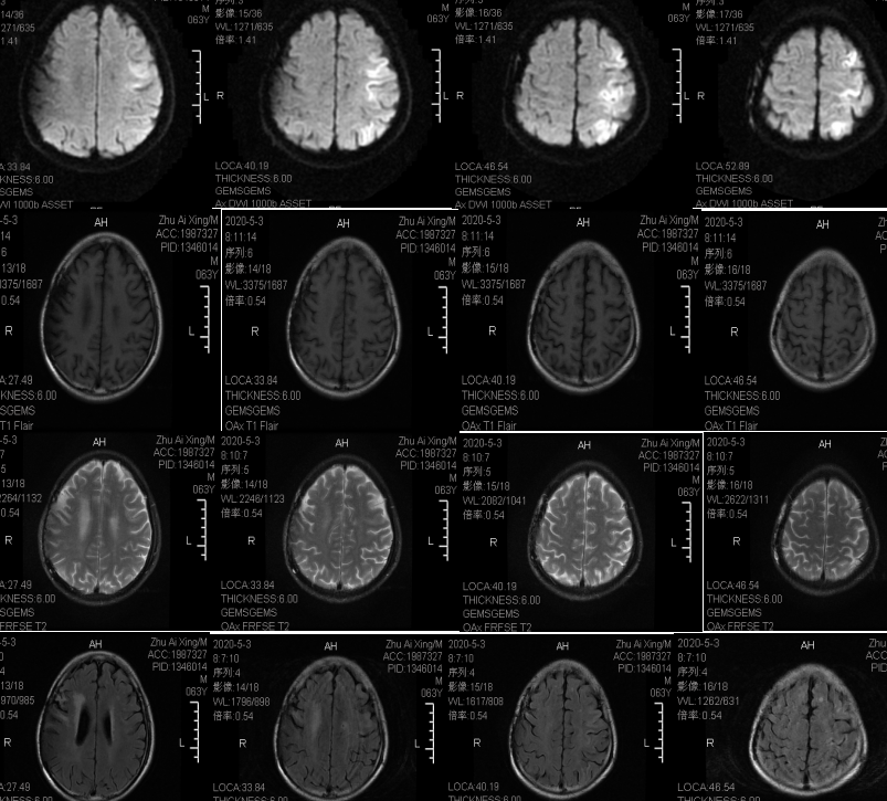 3,两侧侧脑室周围脑白质疏松伴多发缺血灶.