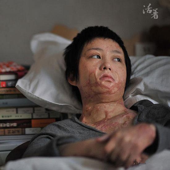 被泼硫酸后该怎么自救?