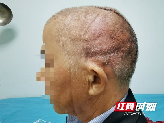 40年野蛮生长米粒大疙瘩长成一大坨肉