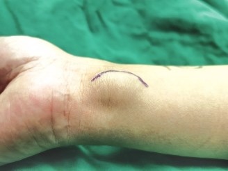 阿明的手腕长了个鹌鹑蛋大的肿瘤