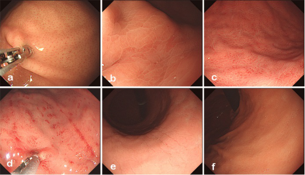 廖娟教授团队揭示胃镜下rac消失与hp感染后引起的胃小凹延长有关