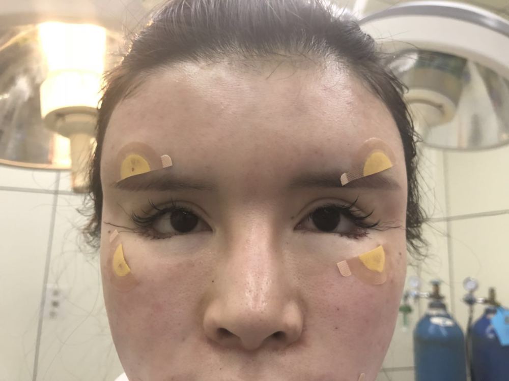 脂肪填充要吃消炎药吗全脸自体的脂肪填充多久消肿