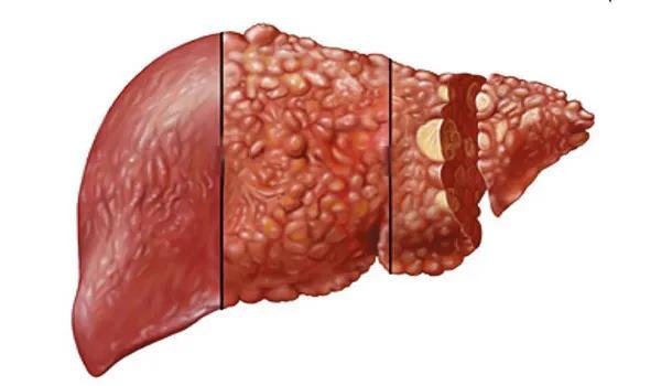 身体出现什么症状,说明肝炎恶变成肝硬化?医生跟你聊一聊