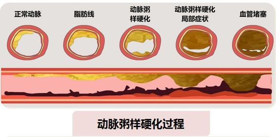 动脉硬化形成的原因图片