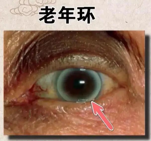 4,老年环3,耳垂的褶皱2,上下眼睑部位的睑黄瘤,手肘脚踝等关节部位的