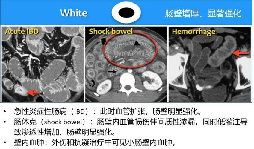 (11)腦室周圍不規則厚壁強化(腦室周圍淋巴瘤) 以小腸壁增厚