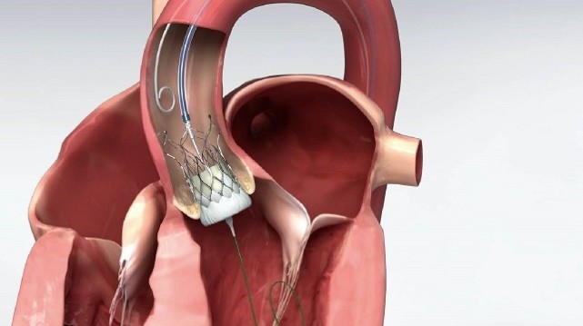 tavr:拯救心脏"大门"的最后一线生机其中,在鲜有人涉足的瓣膜业务领域
