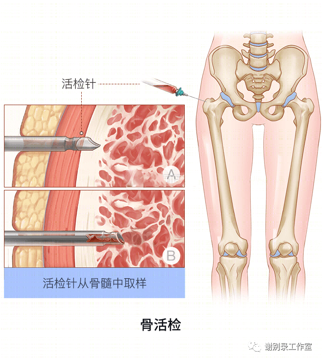 确诊白血病一般需要做哪些检查?"省钱"的检查法子,也许会漏诊或误诊