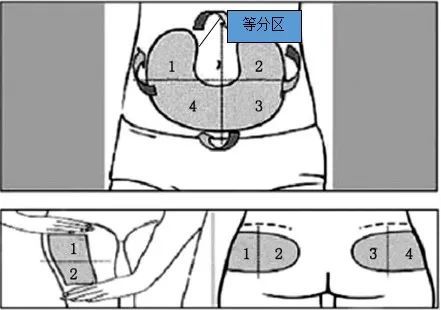 10位患者9位錯胰島素注射規範操作的這些細節真不能馬虎