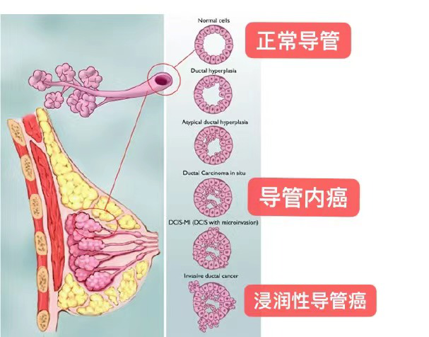 乳腺癌到底从哪里来 癌变 癌细胞 细胞 乳腺癌 乳腺 浸润性导管癌