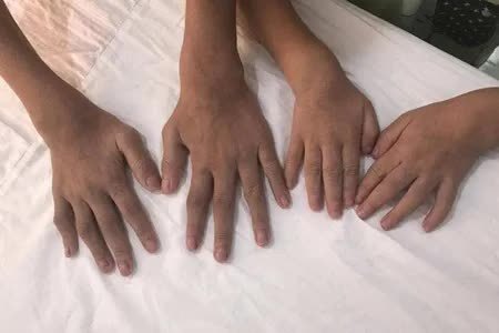 类风湿患者:冬天早上动不了,那是关节在警告你!