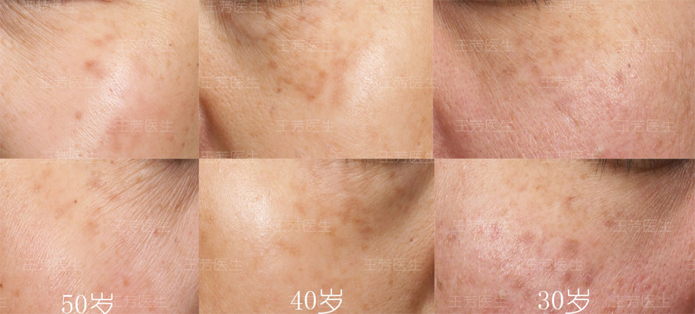 3组褐青色痣案例分享