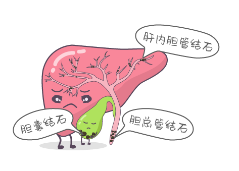 国外对于胆结石的高危人群归纳为5类,称为5f1,fat肥胖随着人们生活