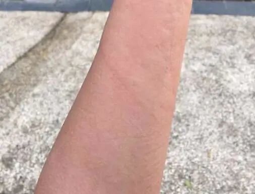 为什么喝蜂蜜过敏?喝完蜂蜜水脸发热怎么回事?_腾讯新闻