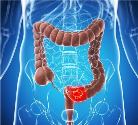 肠道发生病变,多与3件事有关,希望你一个不占!