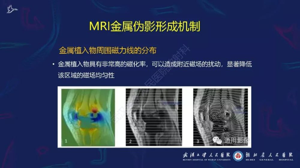 mri金属伪影抑制技术