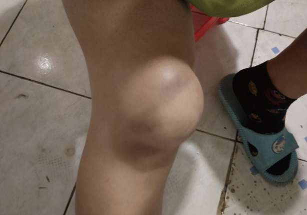 有点慌溜冰摔的膝盖鼓起一个大包专业团队可以抬走了哈哈哈哈