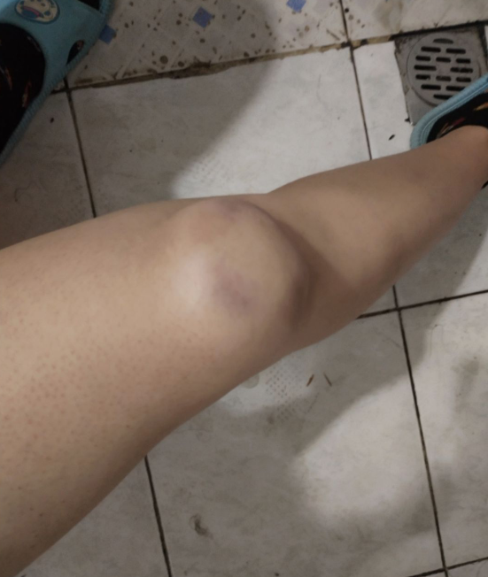 有点慌溜冰摔的膝盖鼓起一个大包专业团队可以抬走了哈哈哈哈