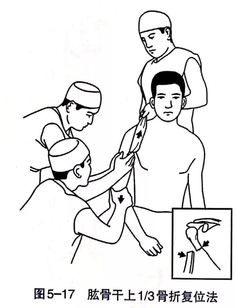 各部位骨折的完美复位手法你值得拥有