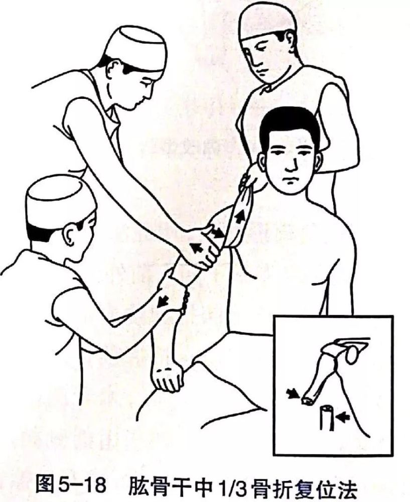 各部位骨折的完美复位手法你值得拥有