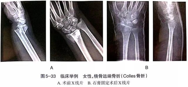 手不向橈側傾斜,尺骨頭的輪廓恢復正常;橈骨下端背側需平坦,且無骨性