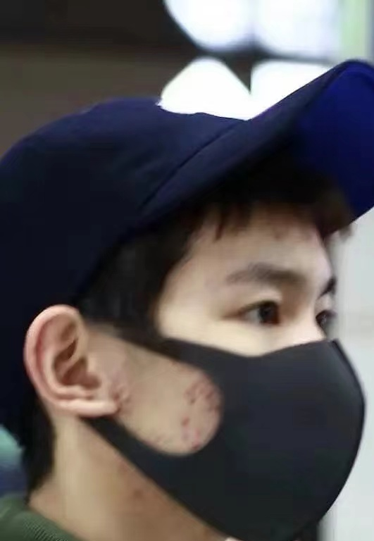 一时间,网上关于他皮肤糟糕的讨论越来越多.