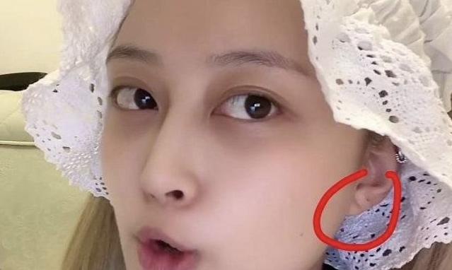 耳垂心脏征的出现可以提示冠心病,具有一定的诊断价值,故又称"冠心病