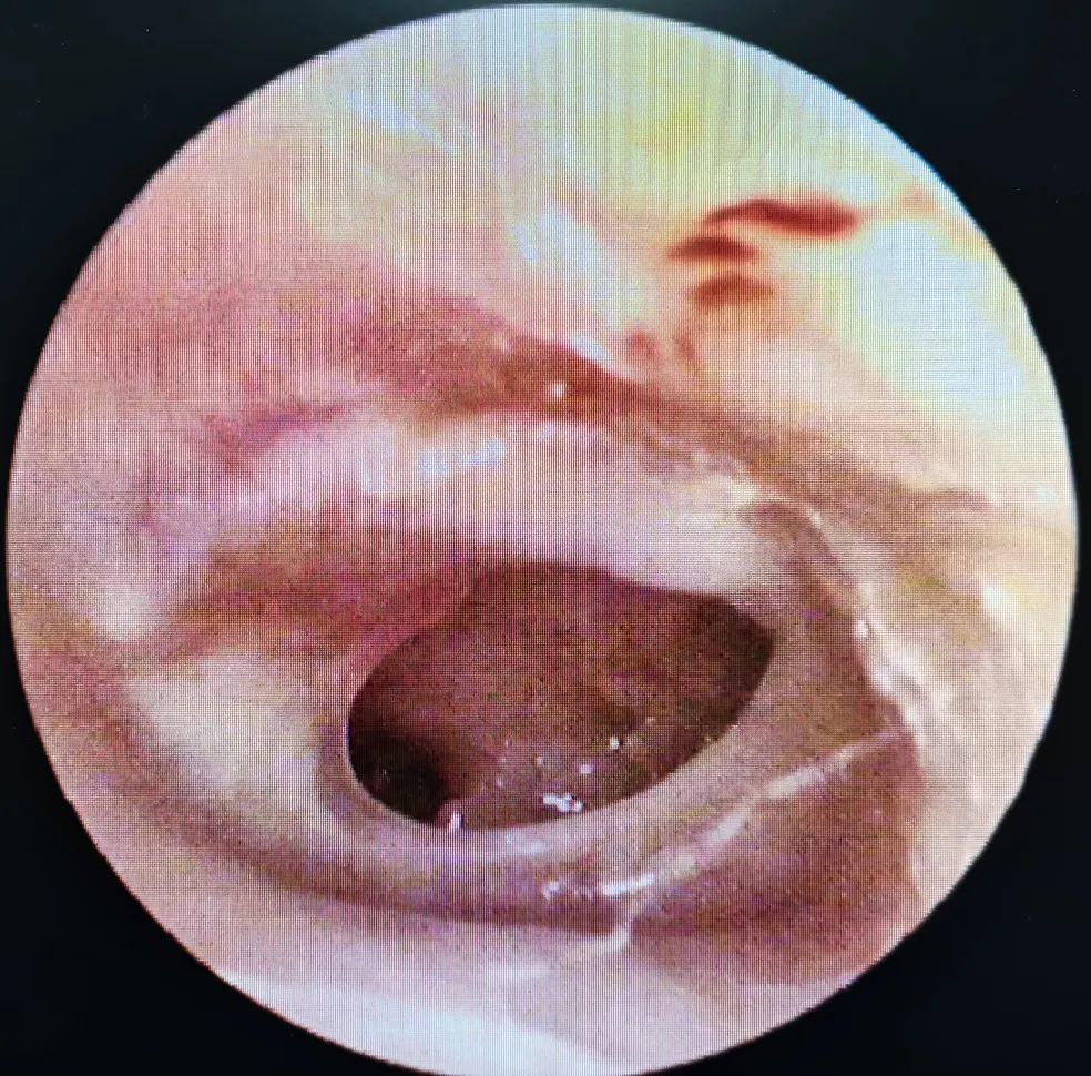 扇了个耳光,这层膜破了…这样的病例台州很常见!