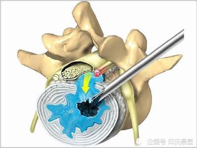 腰椎间盘突出会出现腿麻腰痛坐骨神经痛邱氏悬壶