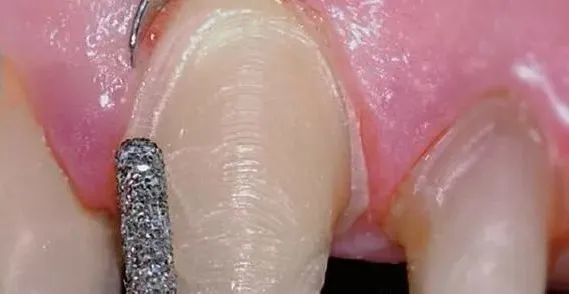 排龈线的选择,及排龈方式的设计