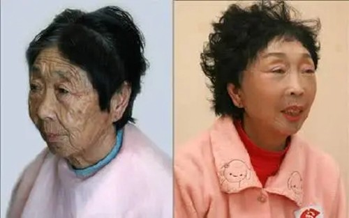 岁,对于她的选择,李玉成也表示支持,很快马玉琴就进行了脸部去皱手术