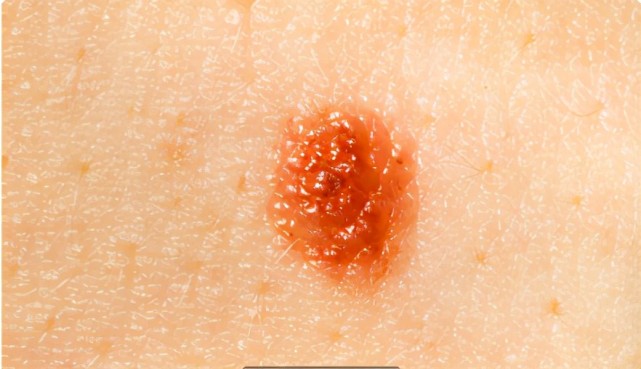 35岁男子皮肤出现蜘蛛痣常用1物肝病绕道走