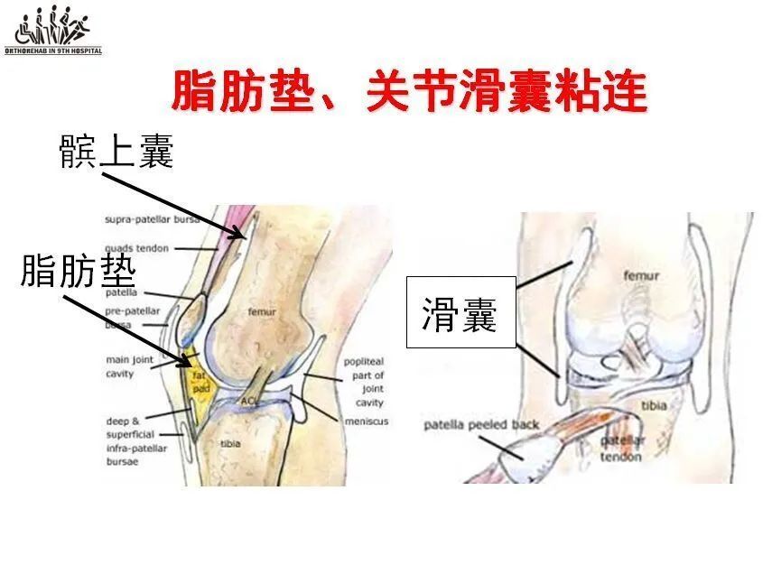 Acl重建术后粘连的康复策略 精品文章 Acl重建必看 腾讯新闻