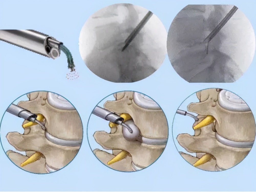 如果无效则考虑微创手术,再无效,最后需切开手术 椎间孔镜手术根据所