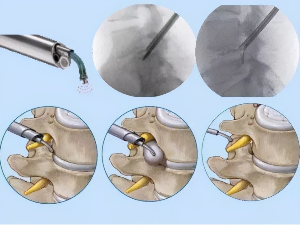 腰椎间盘突出微创术图片