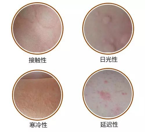 针对湿疹荨麻疹的复发如何解决皮肤瘙痒呢