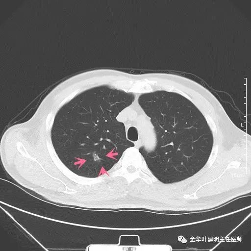 其內少許小條索狀偏高密度此層面看著不舒服,是混合磨玻璃結節,且磨