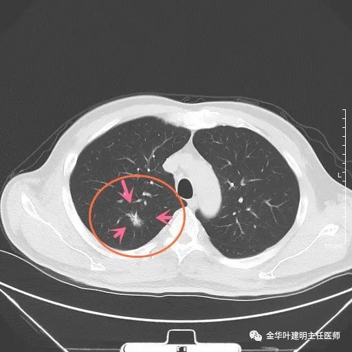 這樣的肺結節不必查增強ct選靶掃描更好