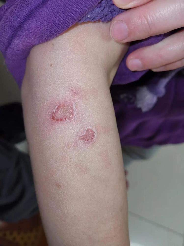 男子看电视时这样做2小时后膝盖起水泡这种病近期高发